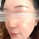 ハイフ（顔） 湘南美容クリニック 岐阜院 DAY 1 サムネイル用