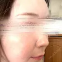 ハイフ（顔） 湘南美容クリニック 岐阜院 DAY 1 サムネイル用