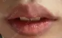 ヒアルロン酸注入（唇） 橿原 BEAUTY CLINIC DAY 7 サムネイル用