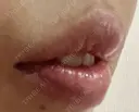 ヒアルロン酸注入（唇） 橿原 BEAUTY CLINIC DAY 7 サムネイル用