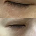 ニードルRF（ポテンツァなど） 表参道スキンクリニック 名古屋院（DAILY SKIN CLINIC提携院） DAY 2 サムネイル用