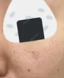 シミ取りレーザー 渋谷美容外科クリニック 横浜院 AFTER サムネイル用