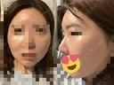 脂肪注入（額） GRACIA clinic 【グラシアクリニック】 DAY 18 サムネイル用