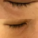 ニードルRF（ポテンツァなど） 表参道スキンクリニック 名古屋院（DAILY SKIN CLINIC提携院） DAY 3 サムネイル用