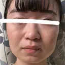 ボトックス（エラ・小顔） 湘南美容クリニック 金山院 DAY 3 サムネイル用