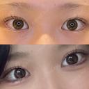 目尻切開 / タレ目形成・グラマラスライン（埋没） / 美容点滴・美容注射（美肌） LOUIS CLINIC 二子玉川院【ルイクリニック】 AFTER サムネイル用