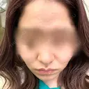 ダーマペン 美容皮膚科しらゆきクリニック DAY 4 サムネイル用