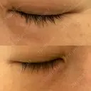 ニードルRF（ポテンツァなど） 表参道スキンクリニック 名古屋院（DAILY SKIN CLINIC提携院） DAY 4 サムネイル用