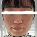 ボトックス（エラ・小顔） 湘南美容クリニック 金山院 DAY 5 サムネイル用