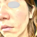 ヒアルロン酸注入（頬） 品川スキンクリニック立川院 AFTER サムネイル用