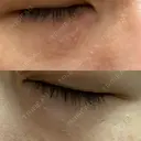 ニードルRF（ポテンツァなど） 表参道スキンクリニック 名古屋院（DAILY SKIN CLINIC提携院） DAY 5 サムネイル用