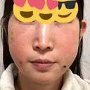 クマ治療 / 脂肪注入（肌） / 脂肪注入（目の下） EMMO FACE CLINIC 大宮院 DAY 0 サムネイル用