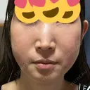 クマ治療 / 脂肪注入（肌） / 脂肪注入（目の下） EMMO FACE CLINIC 大宮院 DAY 1 サムネイル用