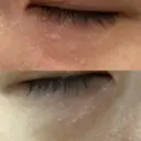 ニードルRF（ポテンツァなど） 表参道スキンクリニック 名古屋院（DAILY SKIN CLINIC提携院） AFTER サムネイル用