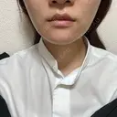 ボトックス（エラ・小顔） 9BeautyClinic AFTER サムネイル用