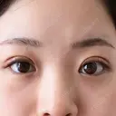 目頭切開 東京エビスクリニック DAY 8 サムネイル用