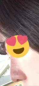 ヒアルロン酸注入（鼻） 共立美容外科 福岡院 AFTER サムネイル用