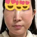 クマ治療 / 脂肪注入（肌） / 脂肪注入（目の下） EMMO FACE CLINIC 大宮院 DAY 3 サムネイル用