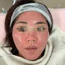 ヴェルヴェットスキン Olino美容外科・美容皮膚科 DAY 0 サムネイル用