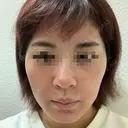 ヴェルヴェットスキン Olino美容外科・美容皮膚科 DAY 1 サムネイル用