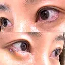 目尻切開 / タレ目形成・グラマラスライン（埋没） / 美容点滴・美容注射（美肌） LOUIS CLINIC 二子玉川院【ルイクリニック】 DAY 3 サムネイル用