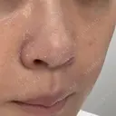 ヴェルヴェットスキン Olino美容外科・美容皮膚科 DAY 2 サムネイル用