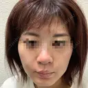 ヴェルヴェットスキン Olino美容外科・美容皮膚科 DAY 2 サムネイル用