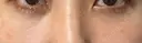 下まぶたたるみ取り エートップ美容整形外科 AFTER サムネイル用