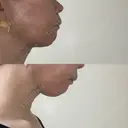 糸リフト / 脂肪吸引（顔） 自由が丘ウェルエイジングビューティークリニック DAY 0 サムネイル用