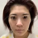 ヴェルヴェットスキン Olino美容外科・美容皮膚科 DAY 4 サムネイル用