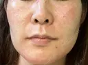 ヴェルヴェットスキン 聖心美容クリニック 広島院 DAY 0 サムネイル用