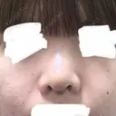 鼻尖形成（切開） / 軟骨移植 MIL CLINIC OSAKA DAY 4 サムネイル用