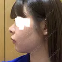 鼻尖形成（切開） / 軟骨移植 MIL CLINIC OSAKA DAY 4 サムネイル用