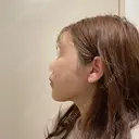 糸リフト / バッカルファット除去 / 脂肪吸引（顔） / 人中短縮 / 脂肪注入（額） / ジョールファット除去 / ヒアルロン酸注入（唇） BLINC CLINIC （ブリンク クリニック） DAY 5 サムネイル用