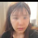 糸リフト / バッカルファット除去 / 脂肪吸引（顔） / 人中短縮 / 脂肪注入（額） / ジョールファット除去 / ヒアルロン酸注入（唇） BLINC CLINIC （ブリンク クリニック） AFTER サムネイル用