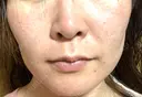 ヴェルヴェットスキン 聖心美容クリニック 広島院 DAY 1 サムネイル用