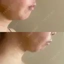 糸リフト / 脂肪吸引（顔） 自由が丘ウェルエイジングビューティークリニック DAY 4 サムネイル用