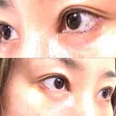 目尻切開 / タレ目形成・グラマラスライン（埋没） / 美容点滴・美容注射（美肌） LOUIS CLINIC 二子玉川院【ルイクリニック】 DAY 7 サムネイル用