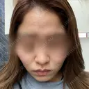 ダーマペン 美容皮膚科しらゆきクリニック AFTER サムネイル用