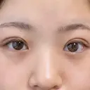 目頭切開 東京エビスクリニック DAY 17 サムネイル用