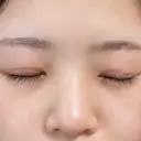 目頭切開 東京エビスクリニック DAY 17 サムネイル用