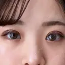 目頭切開 東京エビスクリニック DAY 17 サムネイル用