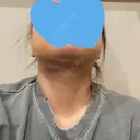 糸リフト / 脂肪吸引（顔） / ジョールファット除去 / ボトックス（エラ・小顔） アリエル美容クリニック 大宮院 DAY 11 サムネイル用