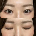 上まぶたの脂肪取り 9BeautyClinic DAY 14 サムネイル用