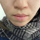 ダーマペン 若倉診療所 DAY 4 サムネイル用