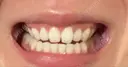 ホワイトニング 目黒まついデンタルクリニック AFTER サムネイル用