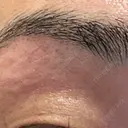 医療脱毛（顔） Jスキンクリニック 【J-SKIN clinic】 DAY 0 サムネイル用
