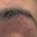 医療脱毛（顔） Jスキンクリニック 【J-SKIN clinic】 DAY 0 サムネイル用