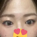 上まぶたの脂肪取り 9BeautyClinic DAY 15 サムネイル用