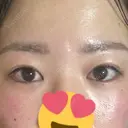 上まぶたの脂肪取り 9BeautyClinic DAY 16 サムネイル用